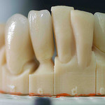 Empreinte numérique - Implants dentaires