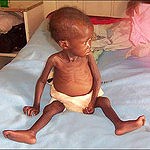 Enfant malnutri, malade