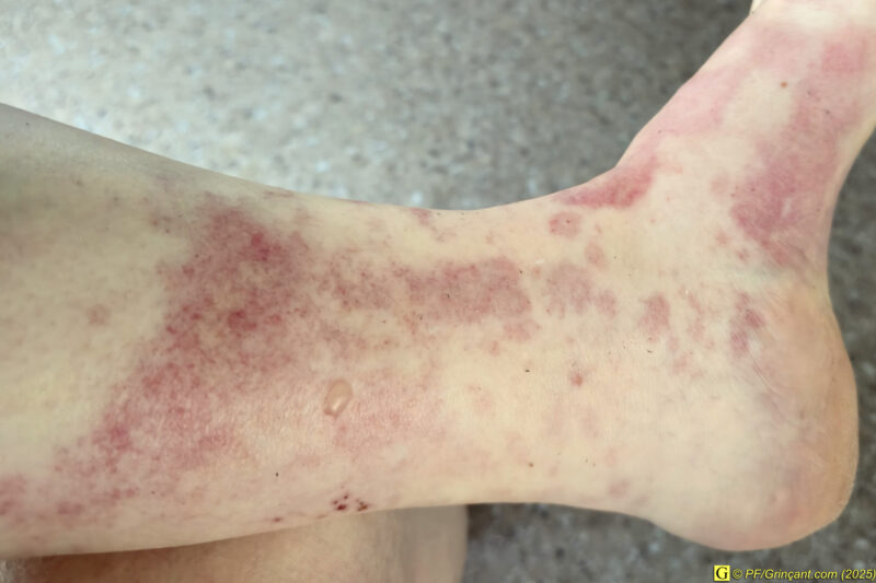 Réaction allergique pieds, chevilles, mollets --> Chaussettes !